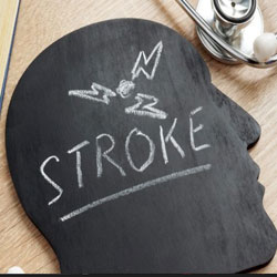 Potential risk of stroke recurrence predicted with Artificial Intelligence