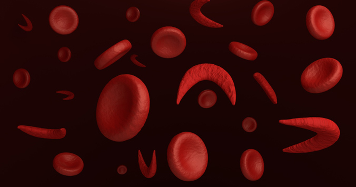 Sickle cell disease: Expanded surveillance, new treatments and the power of music therapy