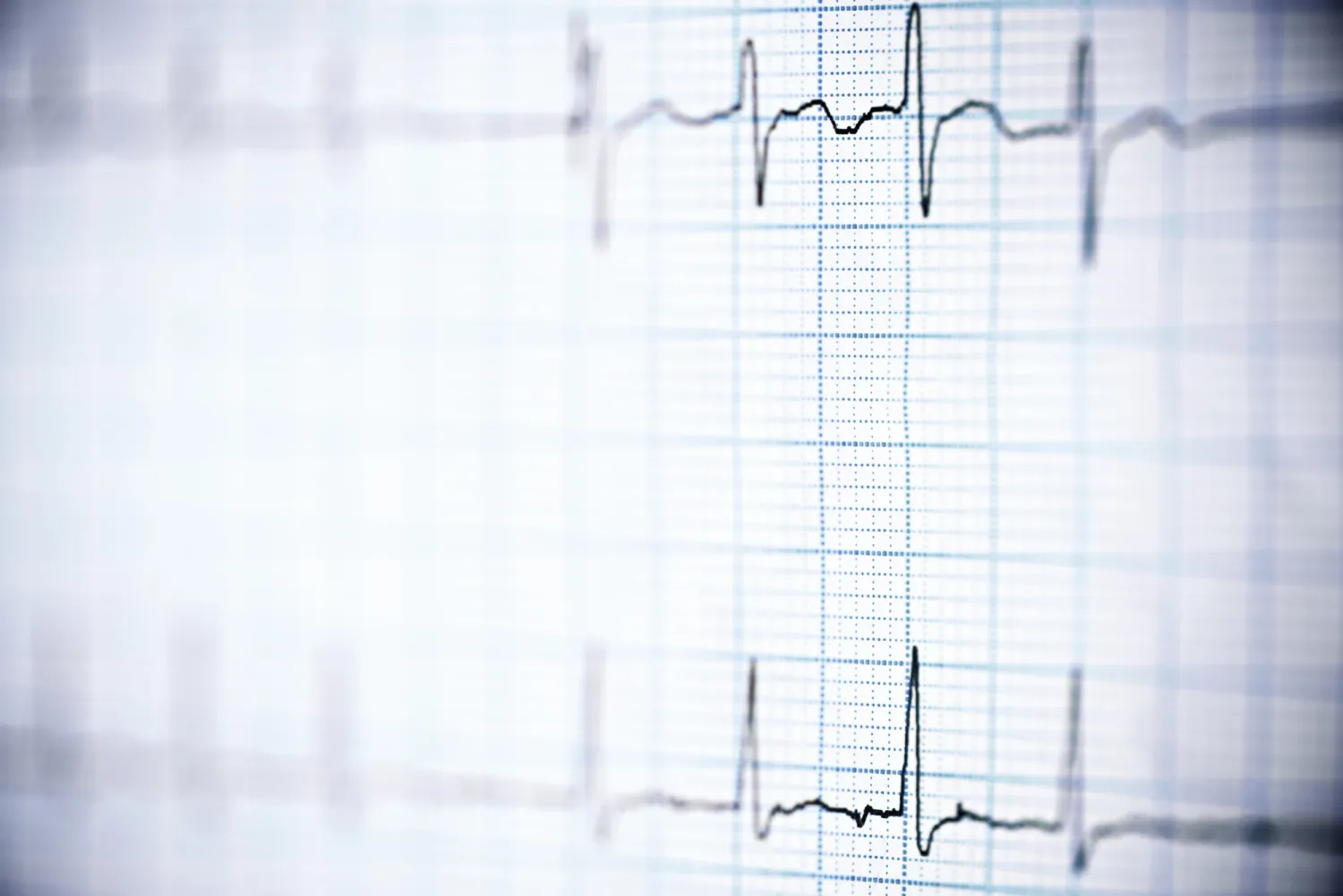 Artificial Intelligence Tools Could Use ECGs to Predict Type 2, Prediabetes